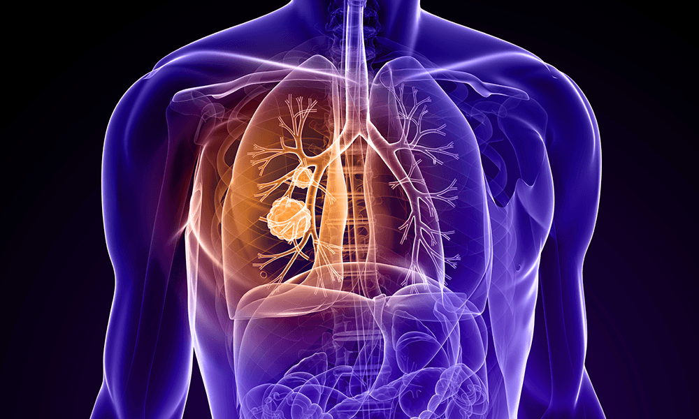 Screenshot of Lung Cancer Detection Tool